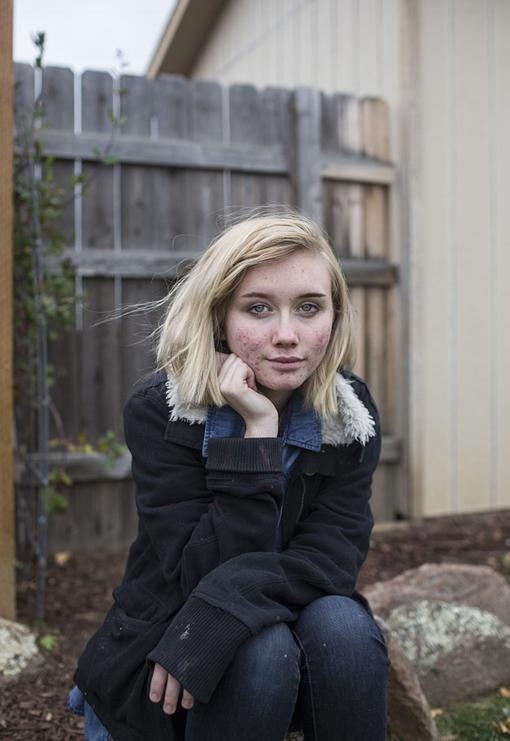 美国女孩满脸粉刺仍自信展现缺陷美