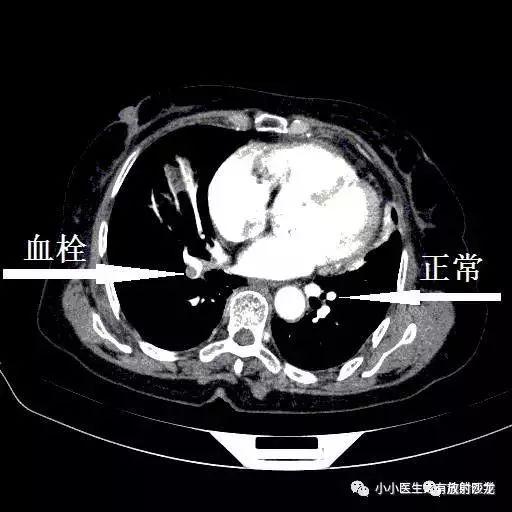 肺栓塞CT轻松入门:我整理的经典图谱,学不会我拜你为师|肺栓塞|血栓|图谱_新浪新闻
