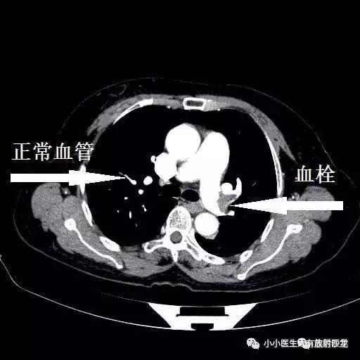 肺栓塞CT轻松入门:我整理的经典图谱,学不会我拜你为师