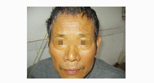 乙肝患者出现这3大症状,说明肝炎准备癌变,挽救肝脏这招要做