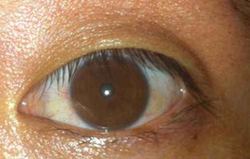 肝病人的眼睛图片图片