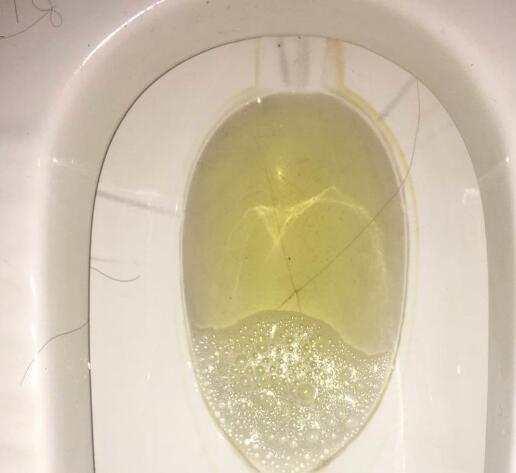 尿液中出现这种情况可能是多种疾病的征兆
