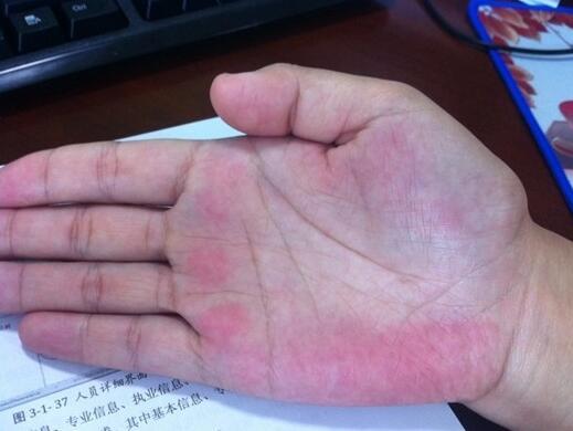 这个部位越黑,那么有黄疸,肝硬化,一点也不奇怪!