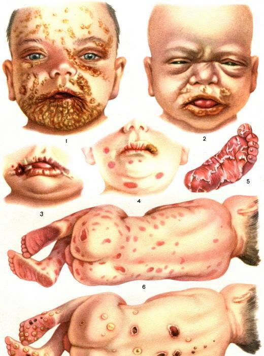 梅毒宝宝的症状有哪些图片