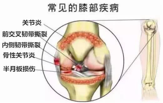 膝盖构造及其损伤原理图片