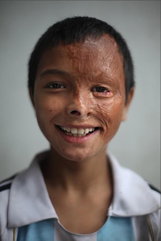 育儿 脖子处严峻烧伤变形,又没钱医治与整容