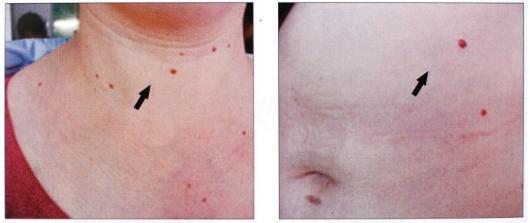 酒精肝患者: 常喝酒要留意身体3个地方变化, 可能你也中招了!