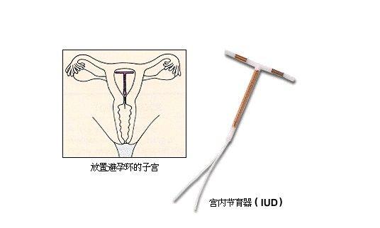 生完孩子后你会"上环"吗?