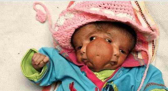 印度婴儿长有"两张脸,被当地人认为神灵转世,都来供奉朝拜