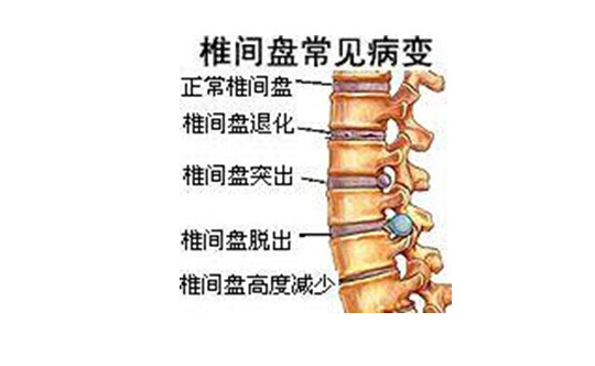 爷爷腰间盘突出难受了十年,却被这个不起眼的小东西痊愈了!厉害