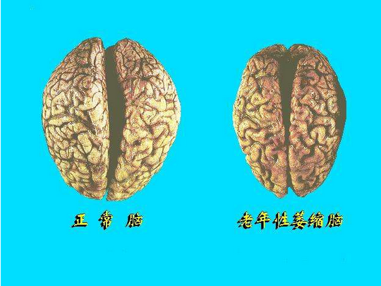 脑萎缩对人体危害有多大,又会带来什么疾病