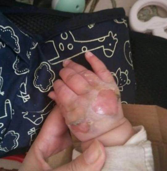 刚满5个月婴儿,就遭了这么大的罪,都怪我这个当妈的不当心!