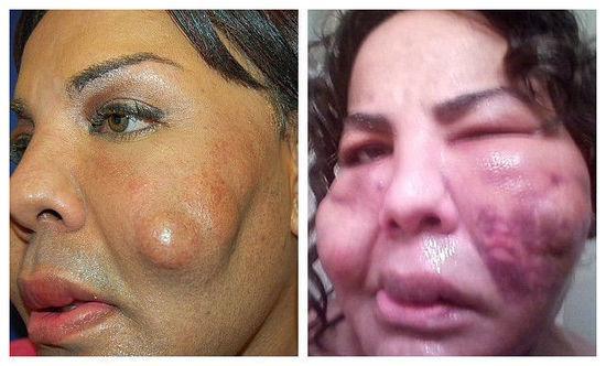 男子为变性选择在黑市整容,如今面部浮肿如同"水泥脸"