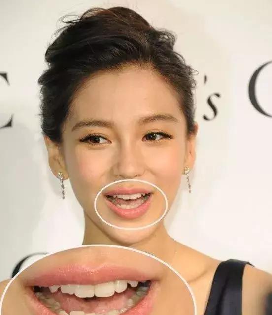 听说angelbaby又整牙啦