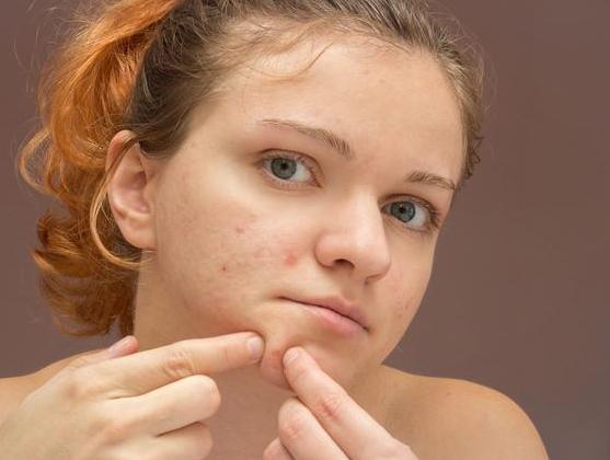 脸上粉刺痘痘能挤出黄颗粒,是毛囊虫来找麻烦了,别大意这个信号