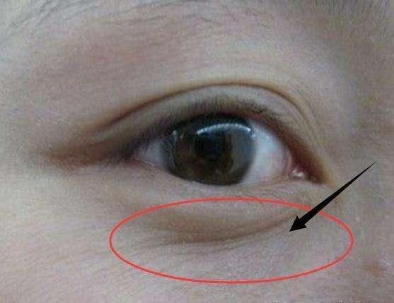 有眼袋,颜值瞬间打对折