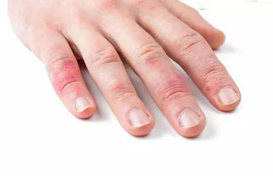 我的湿疹用醋治好了,洗澡后皮肤痒及早预防关