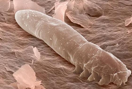 脸上粉刺痘痘能挤出黄颗粒,是毛囊虫来找麻烦了,别大意这个信号