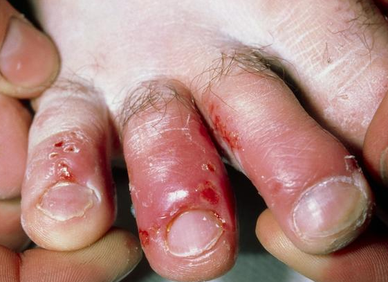 脚气反复发作!网传治疗方法100种,能根治的就这1种