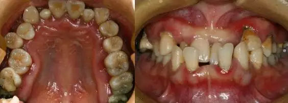 "牙齿不齐"是面子问题,更是健康问题!