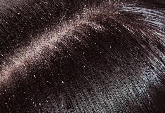 干性发质刚洗完头发还是有头屑1招简单教你去除头屑