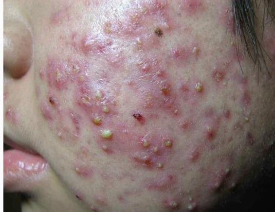 小苏打加软膏祛痘黄金搭档慢慢让你的痘痘去无踪