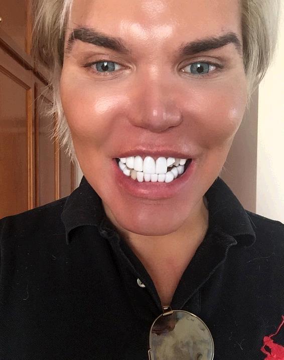 整容60次的整容狂人,花费23万做烤瓷牙,不到一个月牙齿掉了