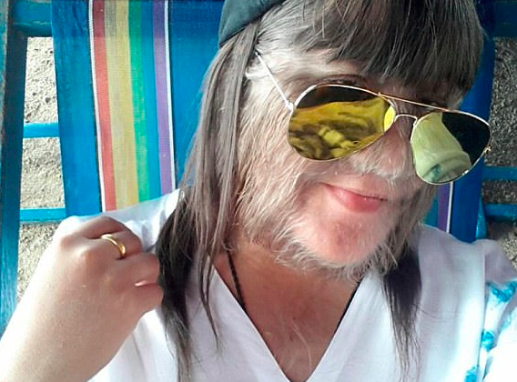 毛发最多的吉尼斯纪录女孩,天生不幸却又是幸运的