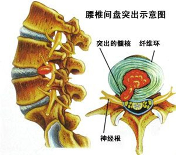 这种小东西,竟然是腰间盘突出的克星,知道的永不复发!