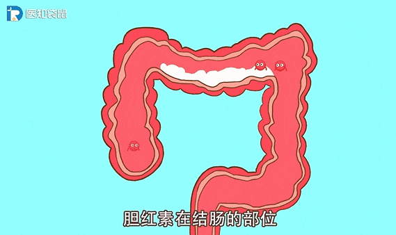 的大便整体是偏酸性的,有可能会导致便便里面的胆红素转变形成胆绿素