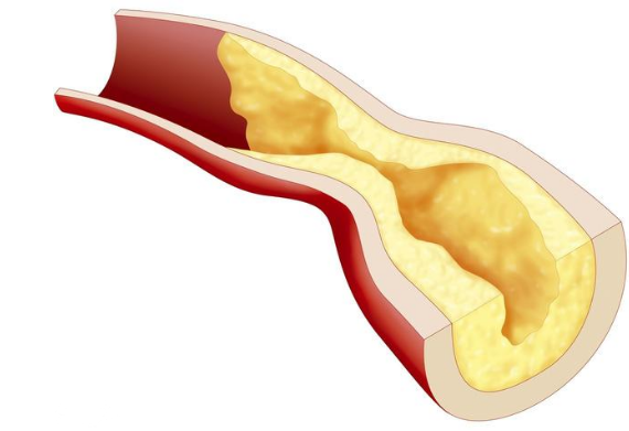 动脉粥样硬化可以逆转,一招可将血管壁清理干净,软化血管溶血栓