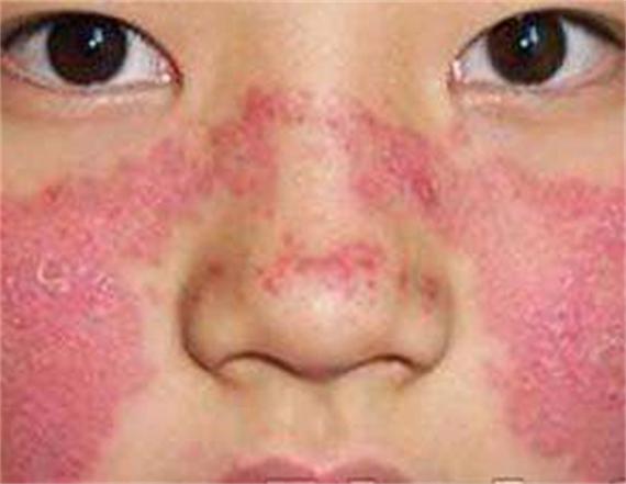 红血丝危害了解红血丝问题严重性