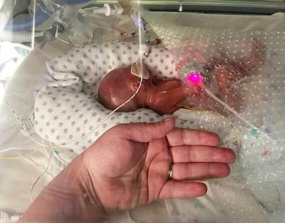 孕妈怀孕7月才堕胎,谁料孩子竟自己出生了,父母决定不放弃他了