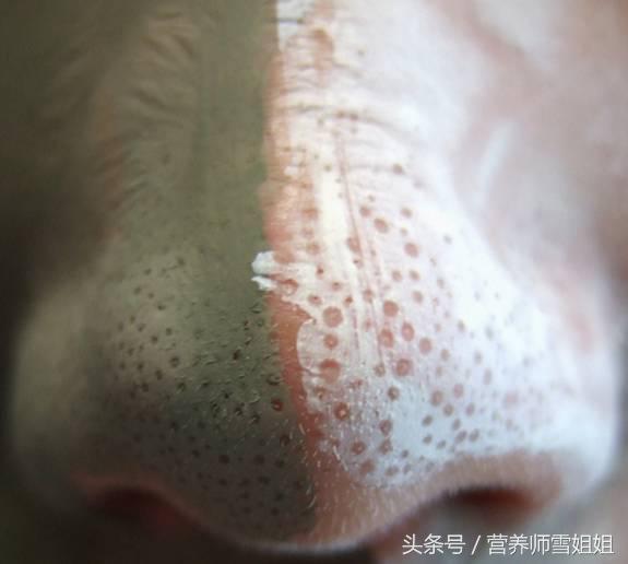 鼻子上挤出的"白色物体"到底是啥?