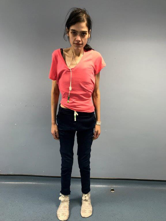 英国胖女孩187斤因病暴瘦至77斤,已为自己筹划葬礼