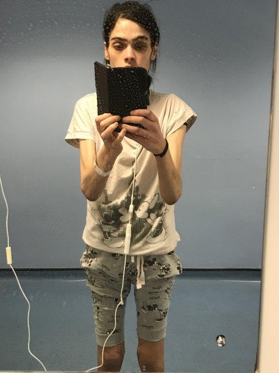 英国胖女孩187斤因病暴瘦至77斤,已为自己筹划葬礼