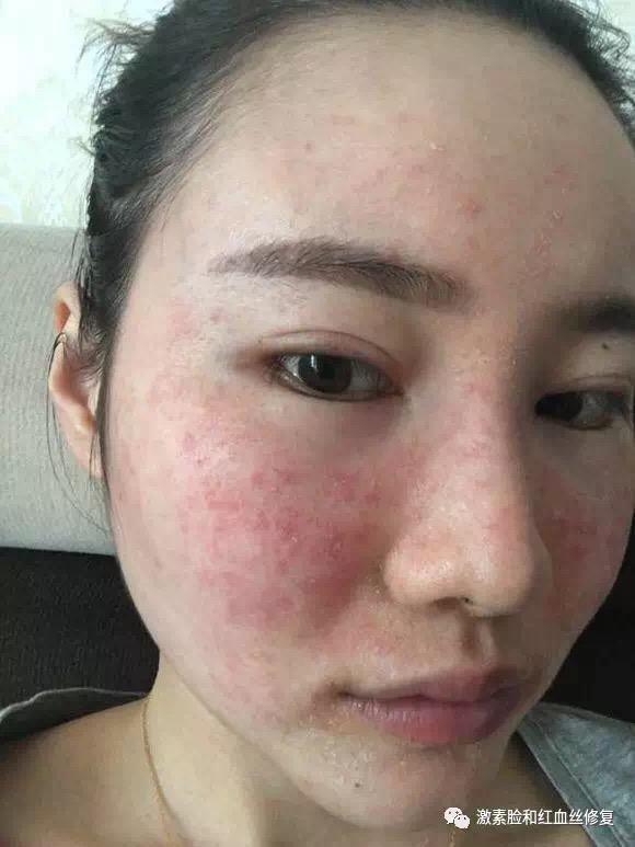 肌肤会变得特别的干,敏感,出现红血丝,严重还会皮肤萎缩,这就是激素