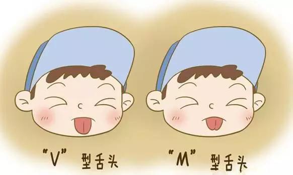 不能伸到口外;在舌体前伸或牵拉时可见到舌背出现小凹陷,舌尖呈"w"型