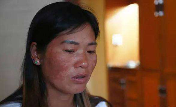 女友容貌被毁我提出分手,一年后我生病住院,她给我汇来五万块钱