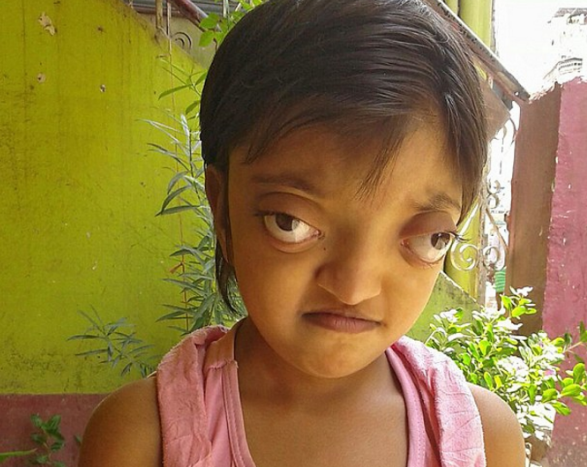 七岁女孩患上"青蛙眼"可令人傻眼的是很多家长向女孩订婚要娶她