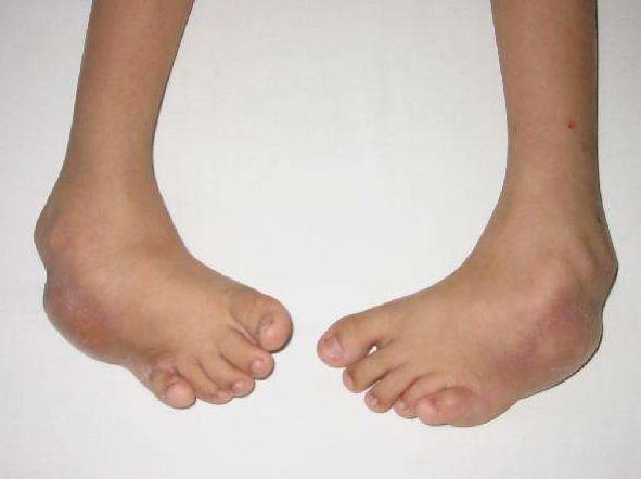 妈妈做了这件事让宝宝双足畸形把为了你好当口头语的父母错了