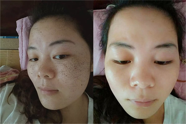 老年斑不用慌张有一种美白乳膏祛斑效果不输激光