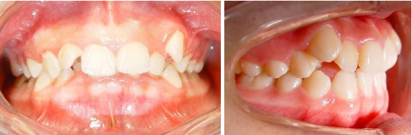 引起错颌畸形的常见原因有哪些?