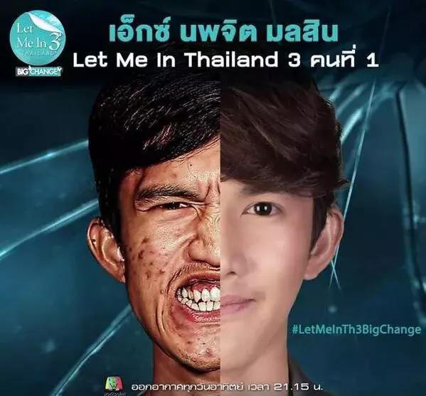 泰国丑男下巴天生歪斜,吃饭喝水倒流,整容后变成大帅哥