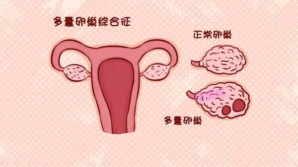 患有多囊卵巢综合征该怎么备孕?这3招你一定要知道