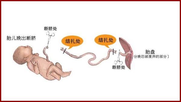 一个月的婴儿脐带护理方法,谨慎预防脐带发炎