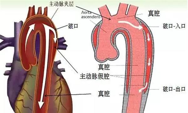 主动脉夹层是什么病症?它有哪些临床表现?