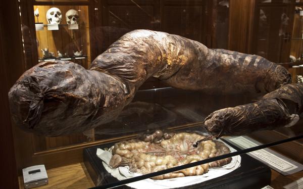腹内36斤"粪味香肠"被捧进博物馆美国费城医学院附设马特博物馆