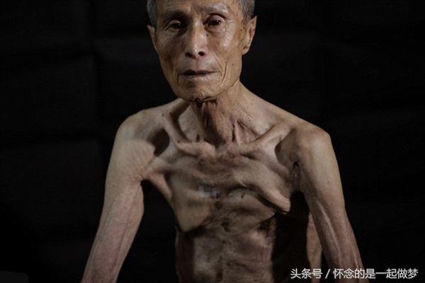 原子弹爆炸下的幸存者,这位老人坑洼的身体看着让人心疼掉泪