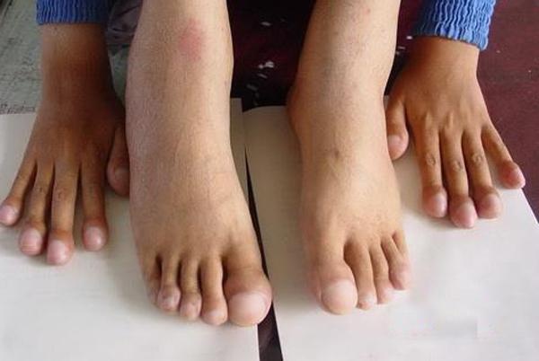 脚部出现6种症状,千万别忽视,这是你的身体在拉响健康警报